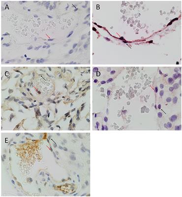 Expression of Embryonic Stem Cell Markers on the Microvessels of WHO Grade I Meningioma